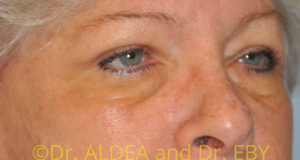 After Image: Blepharoplasty #419 - right-front-oblique