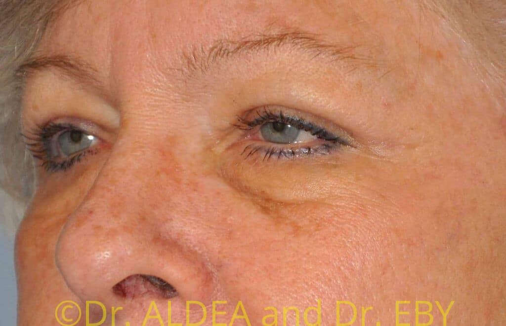 After Image: Blepharoplasty #419 - left-front-oblique