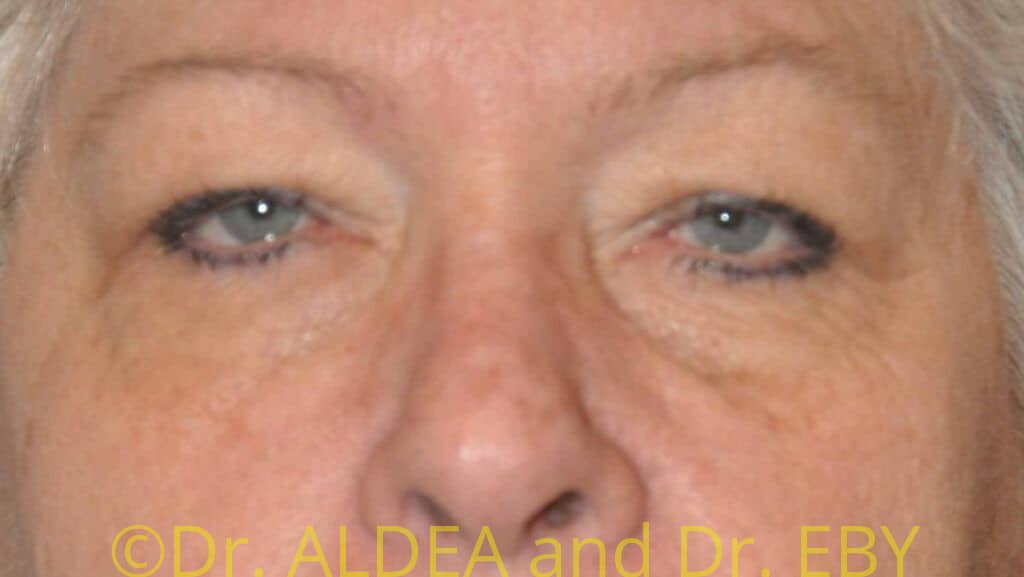 Before Image: Blepharoplasty #419 - front