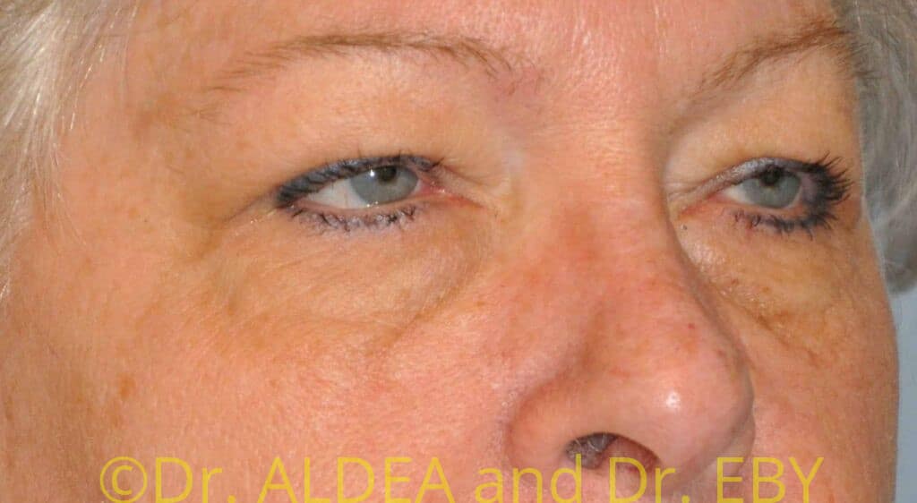 Before Image: Blepharoplasty #419 - right-front-oblique