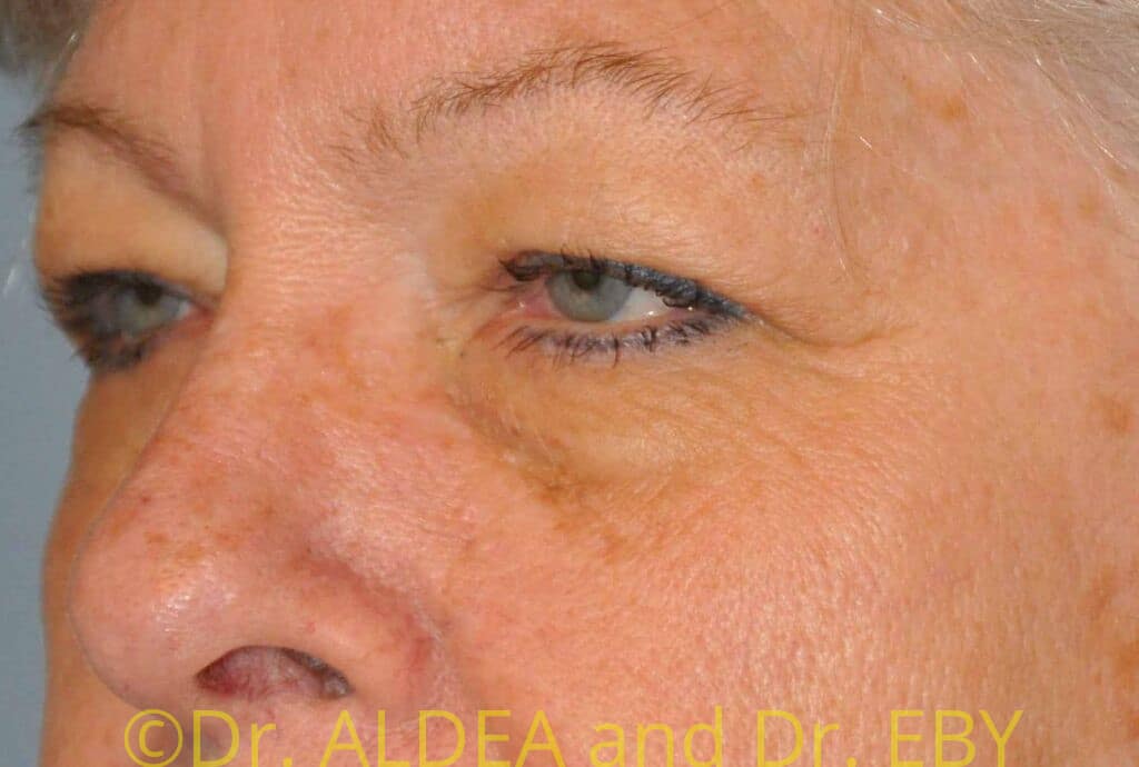 Before Image: Blepharoplasty #419 - left-front-oblique