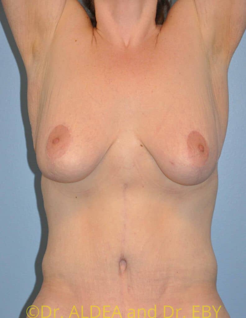 After Image: Short Scar Breast Lift (Mastopexy) #375 - front