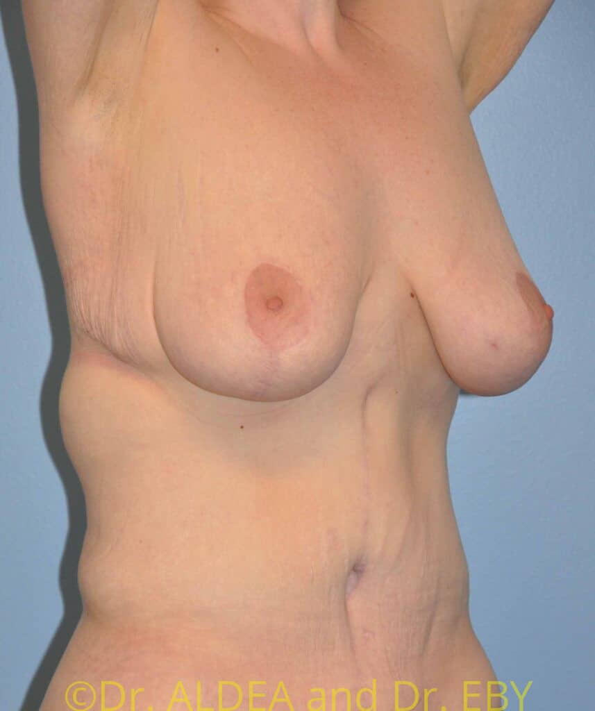 After Image: Short Scar Breast Lift (Mastopexy) #375 - right-front-oblique