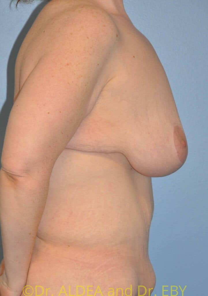After Image: Short Scar Breast Lift (Mastopexy) #375 - right-side
