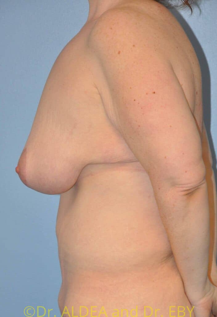 After Image: Short Scar Breast Lift (Mastopexy) #375 - left-side