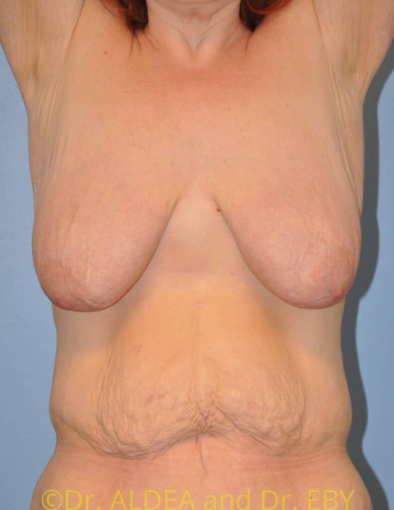 Before Image: Short Scar Breast Lift (Mastopexy) #375 - front