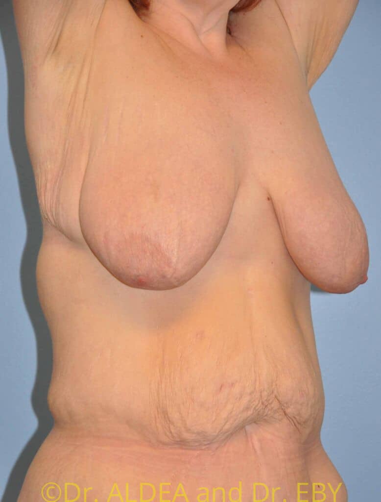 Before Image: Short Scar Breast Lift (Mastopexy) #375 - right-front-oblique