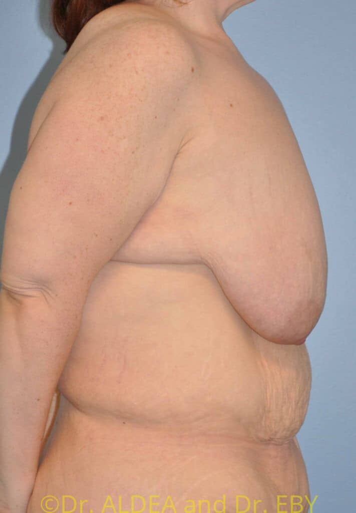 Before Image: Short Scar Breast Lift (Mastopexy) #375 - right-side