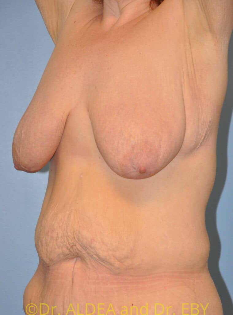 Before Image: Short Scar Breast Lift (Mastopexy) #375 - left-front-oblique