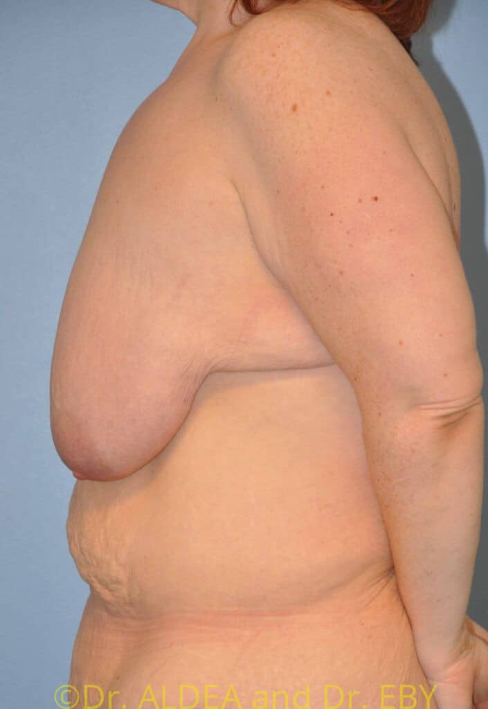 Before Image: Short Scar Breast Lift (Mastopexy) #375 - left-side