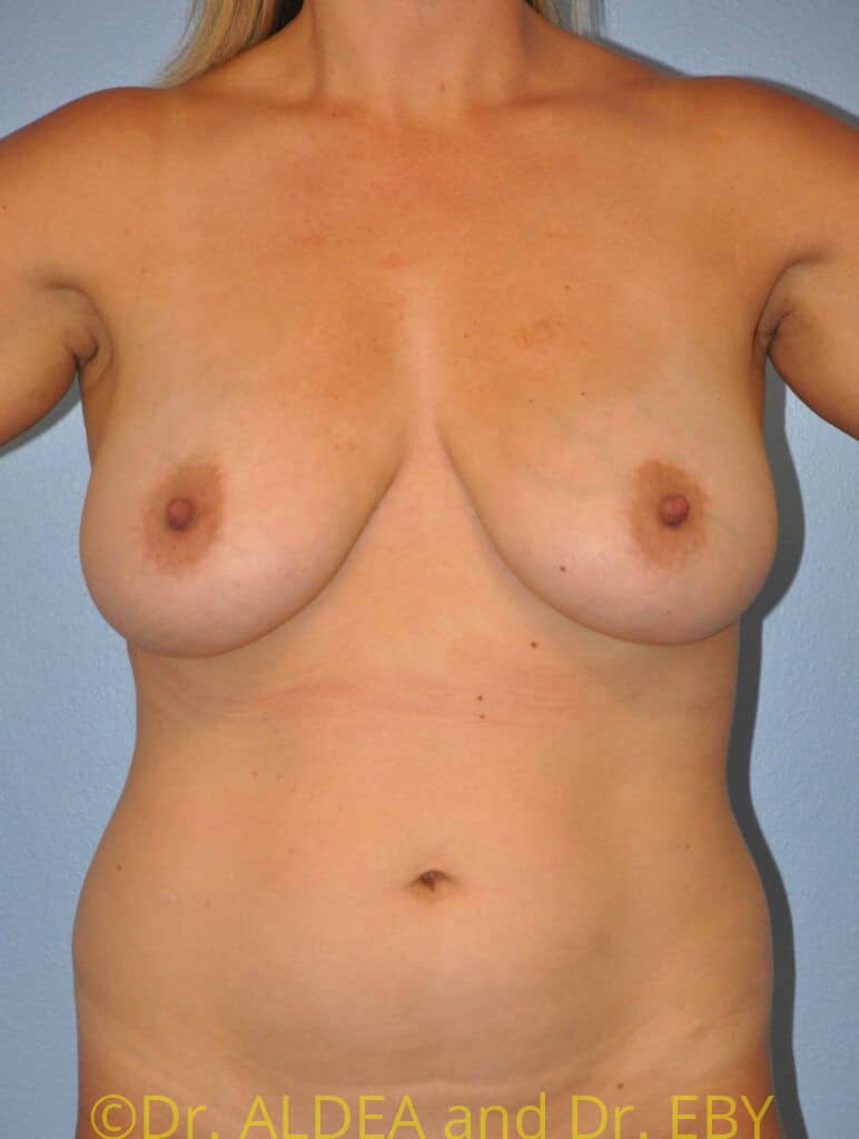 Before Image: Short Scar Breast Reduction #988 - front