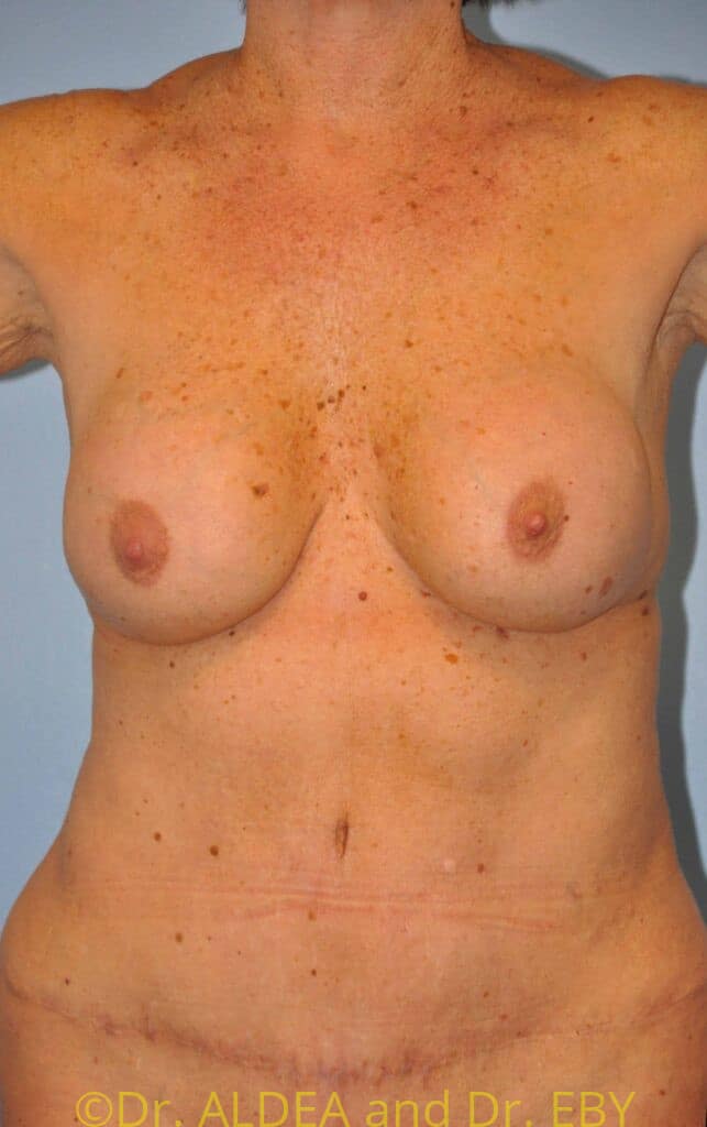 Before Image: Breast Implant Removal (Explantation) WITH a Lift #846 - front