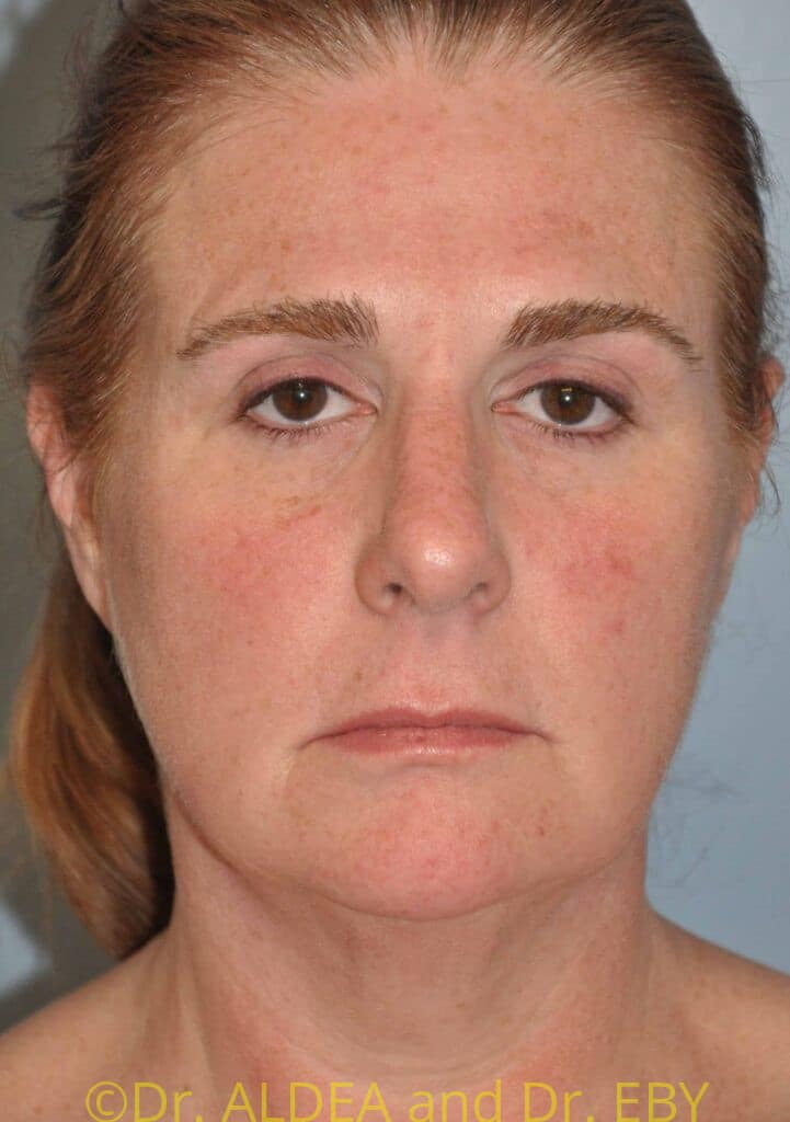 Before Image: Facelift #297 - front