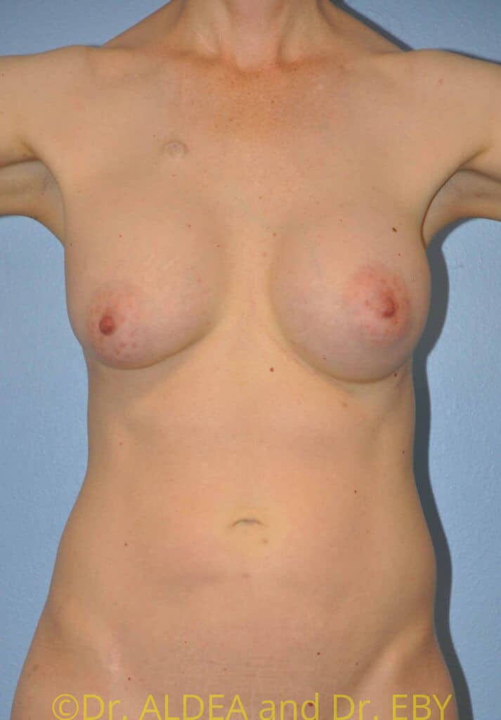 Before Image: Fat Transfer to Breasts #836 - front