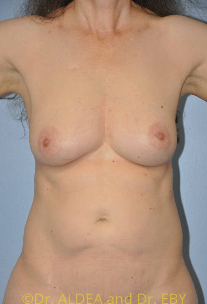 After Image: Fat Transfer to Breasts #836 - front