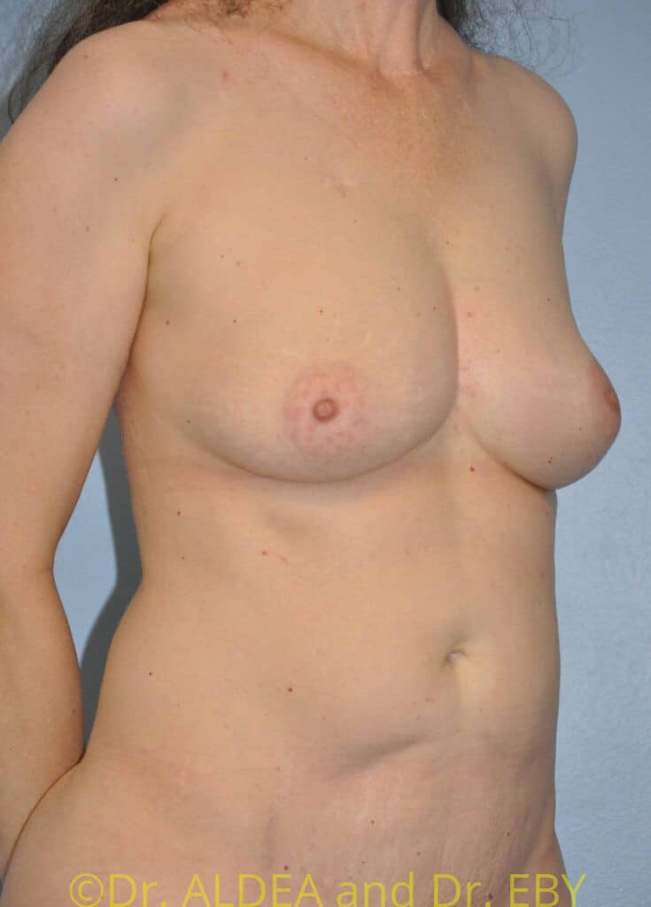 After Image: Fat Transfer to Breasts #836 - right-front-oblique