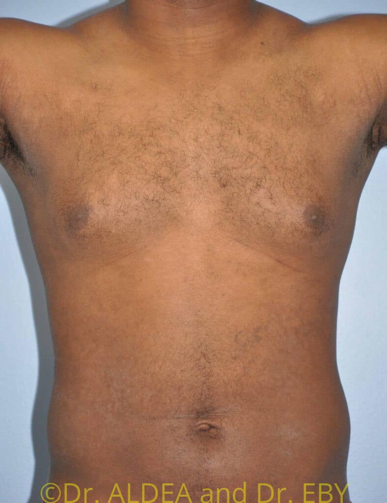 Before Image: Gynecomastia #607 - front