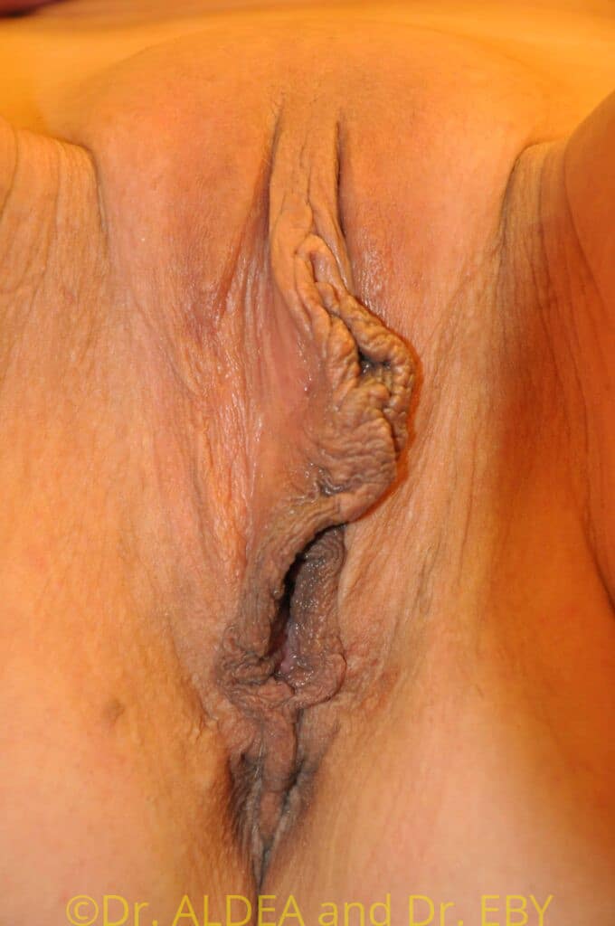 Before Image: Labiaplasty #471 - front