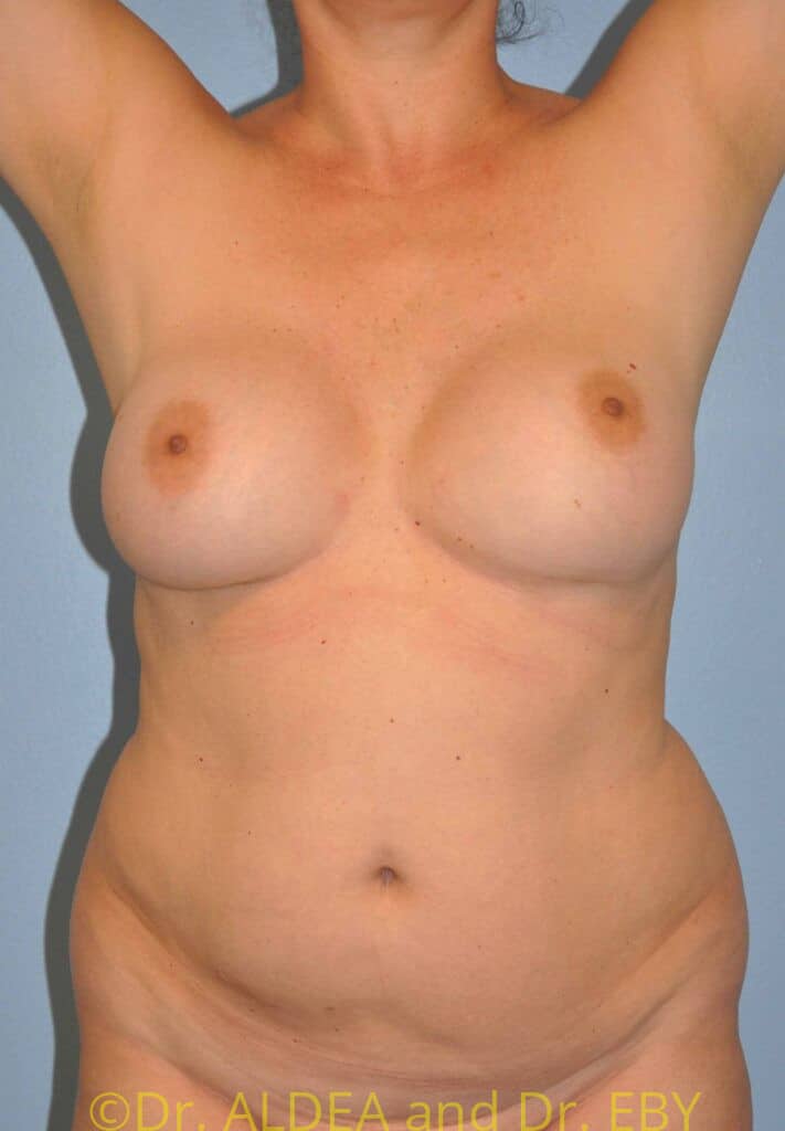 Before Image: Liposuction #384 - front