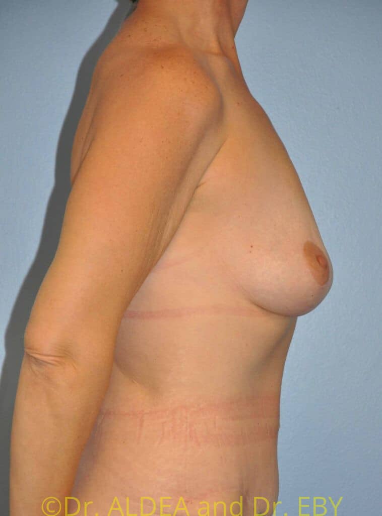 After Image: Mommy Makeover #363 - right-side