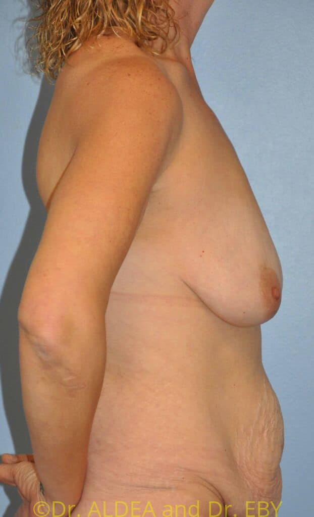 Before Image: Mommy Makeover #363 - right-side