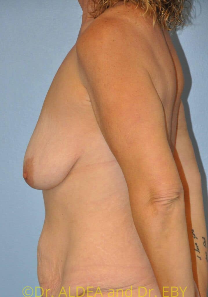 Before Image: Mommy Makeover #363 - left-side