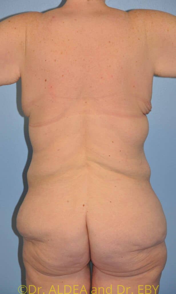 Before Image: Weight loss (MWL) Butt and Thigh Lift #150 - back