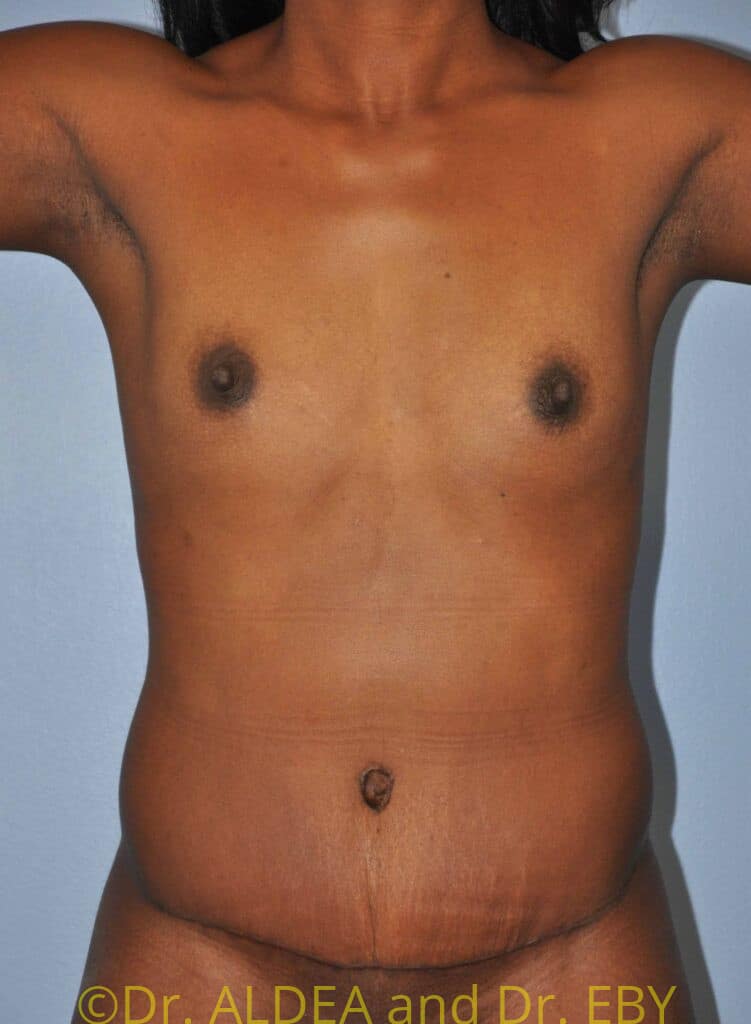 After Image: Tummy Tuck #280 - front