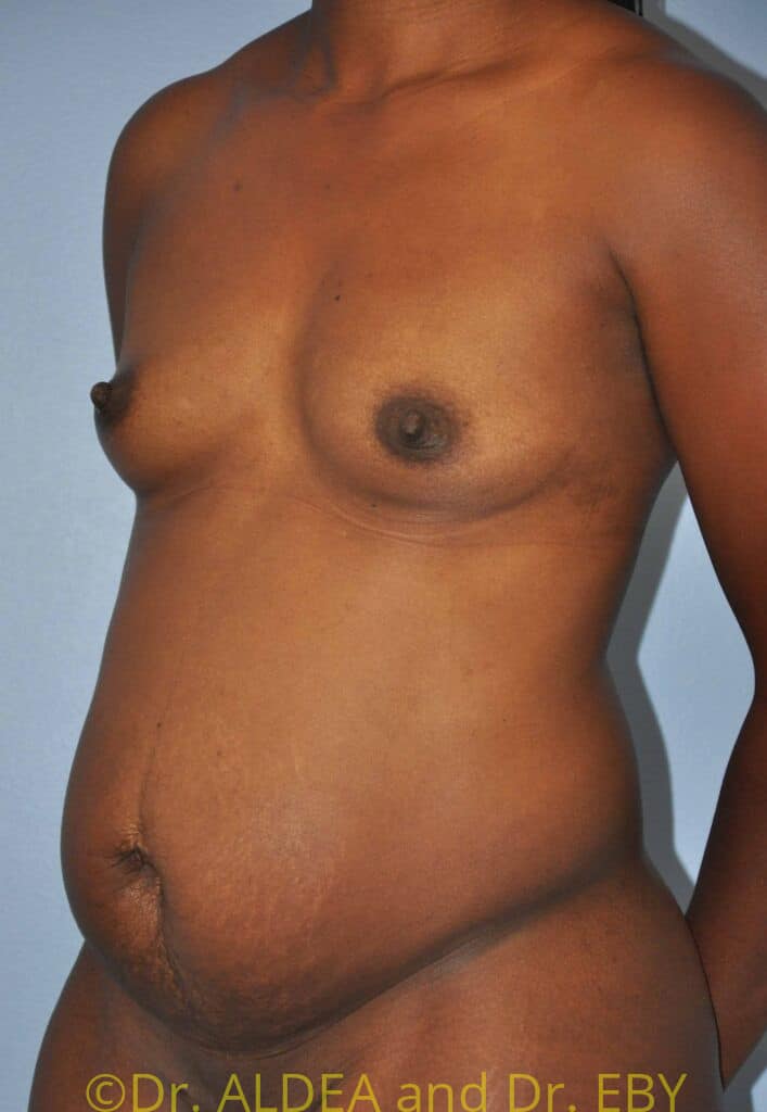 Before Image: Tummy Tuck #280 - left-front-oblique