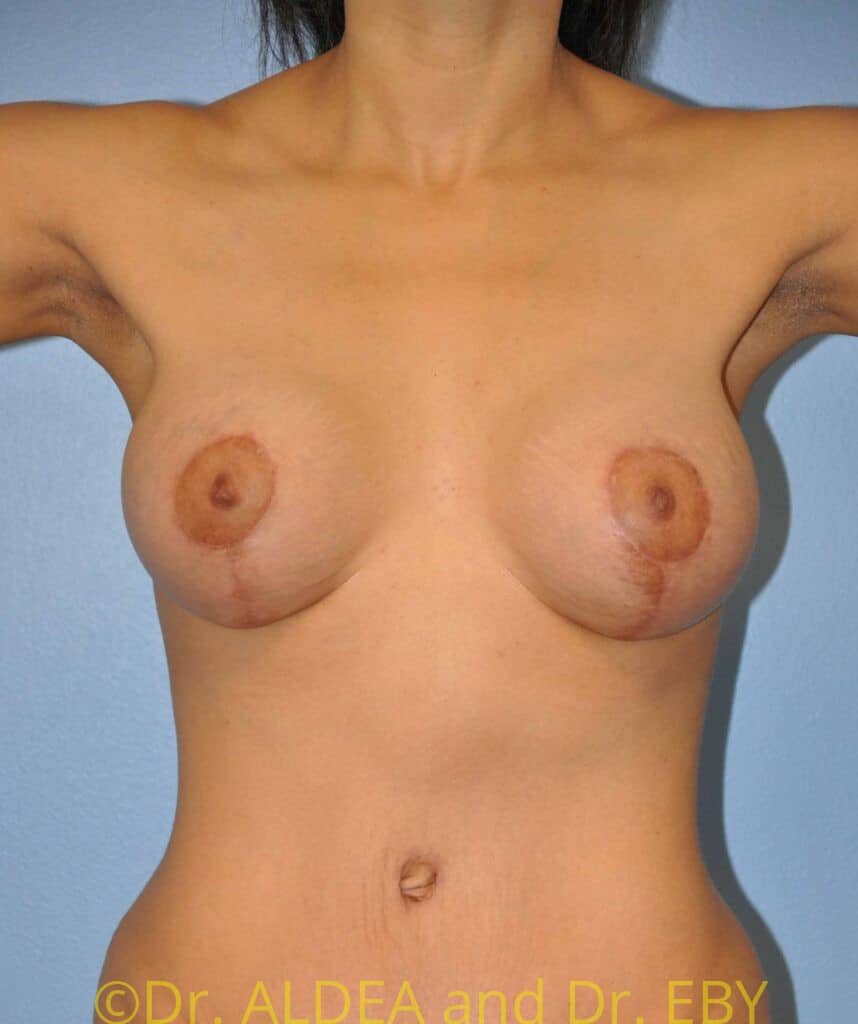 After Image: Breast Augmentation w/ Lift #435 - front