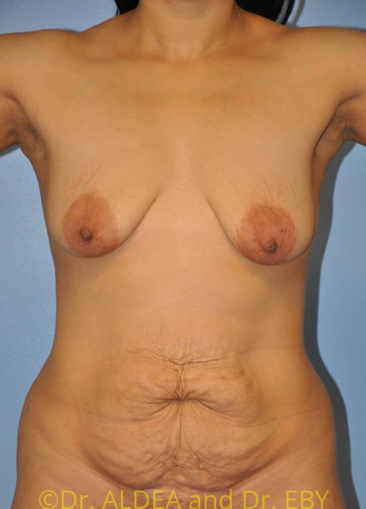 Before Image: Breast Augmentation w/ Lift #435 - front