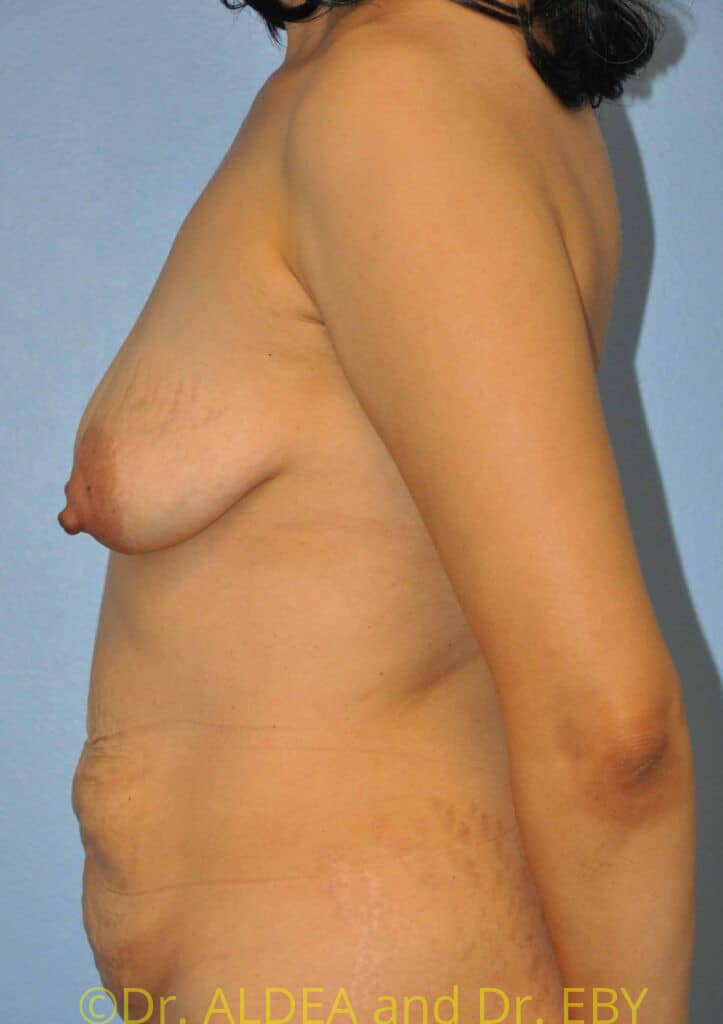Before Image: Breast Augmentation w/ Lift #435 - left-side