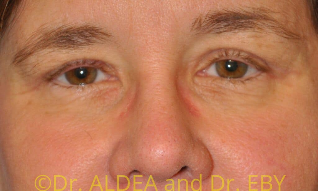 After Image: Blepharoplasty #707 - front