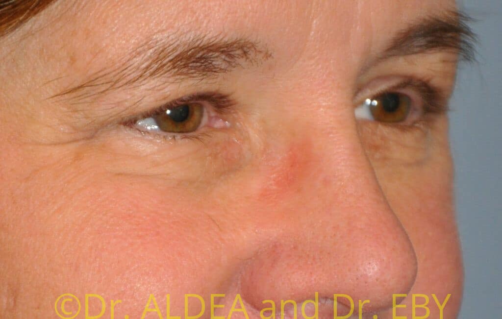 After Image: Blepharoplasty #707 - right-front-oblique