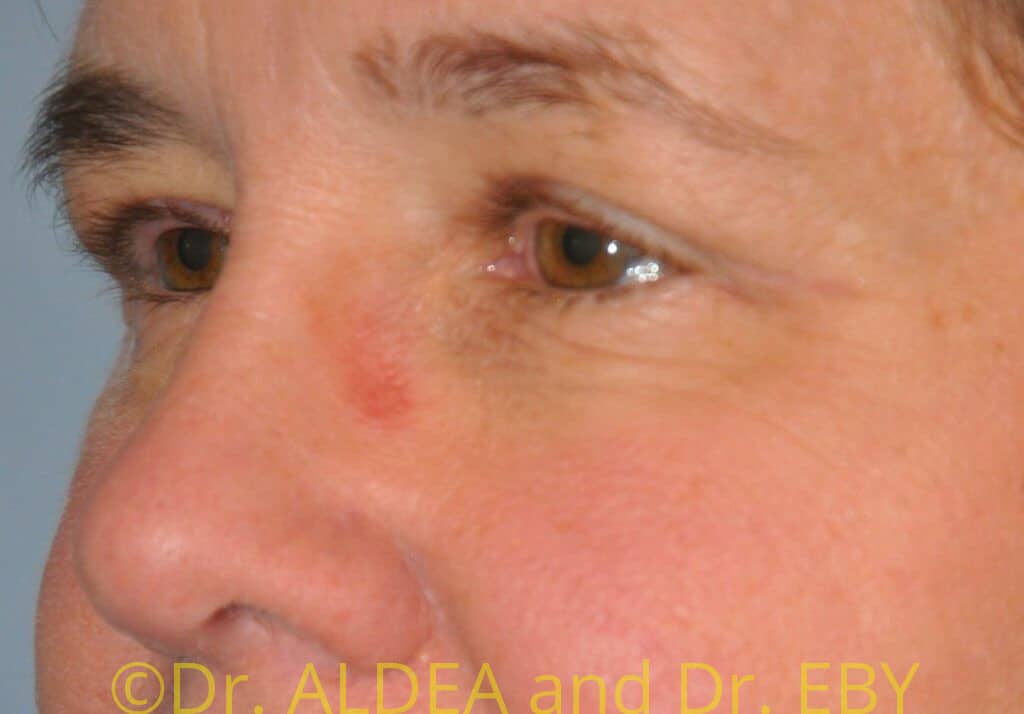 After Image: Blepharoplasty #707 - left-front-oblique
