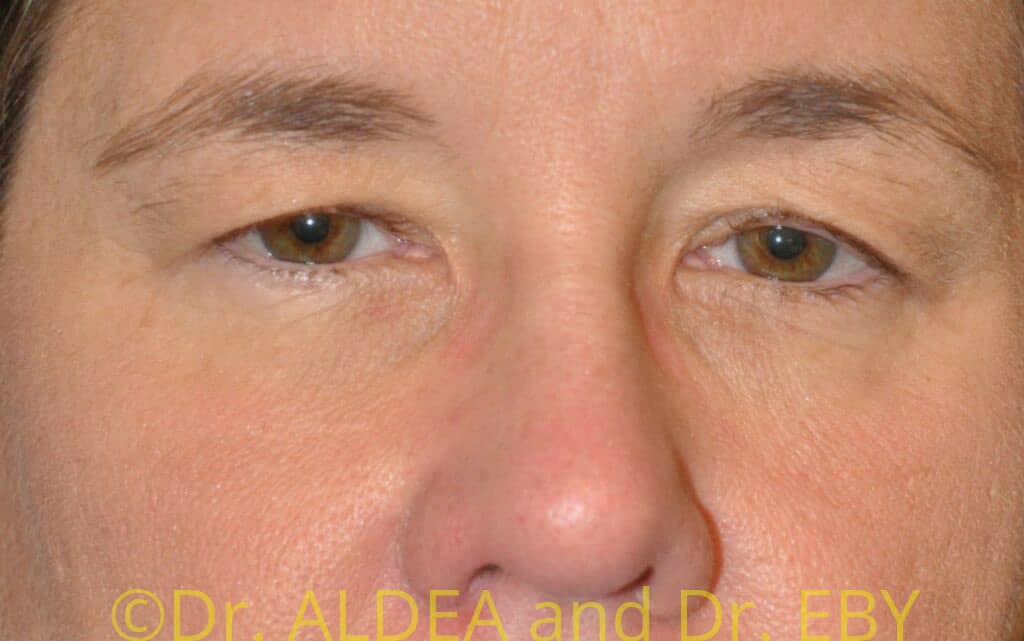 Before Image: Blepharoplasty #707 - front