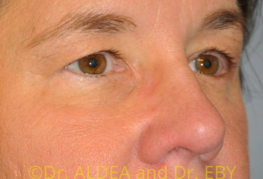 Before Image: Blepharoplasty #707 - right-front-oblique
