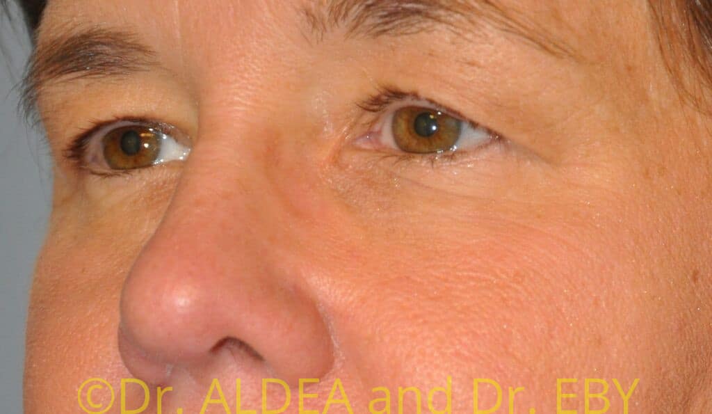 Before Image: Blepharoplasty #707 - left-front-oblique