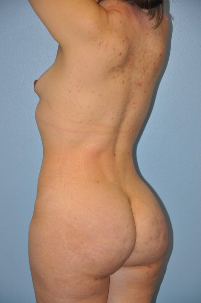 After Image: Precision BBL #749 - left-back-oblique