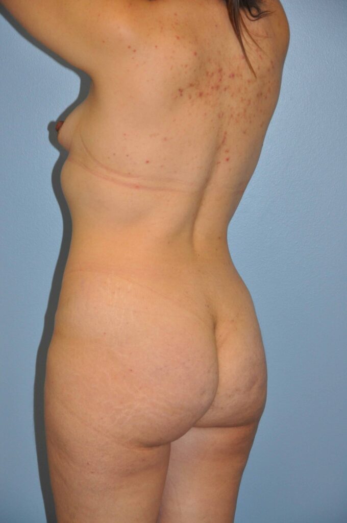 Before Image: Precision BBL #749 - left-back-oblique