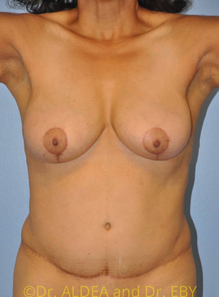 After Image: Short Scar Breast Lift (Mastopexy) #887 - front