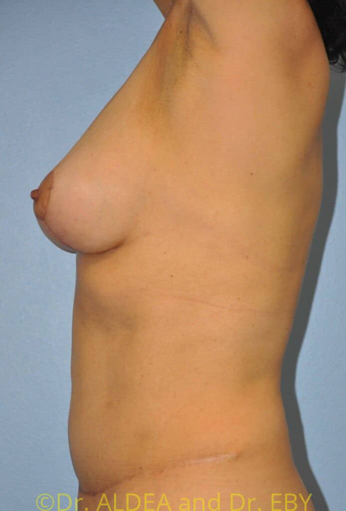 After Image: Short Scar Breast Lift (Mastopexy) #887 - left-side