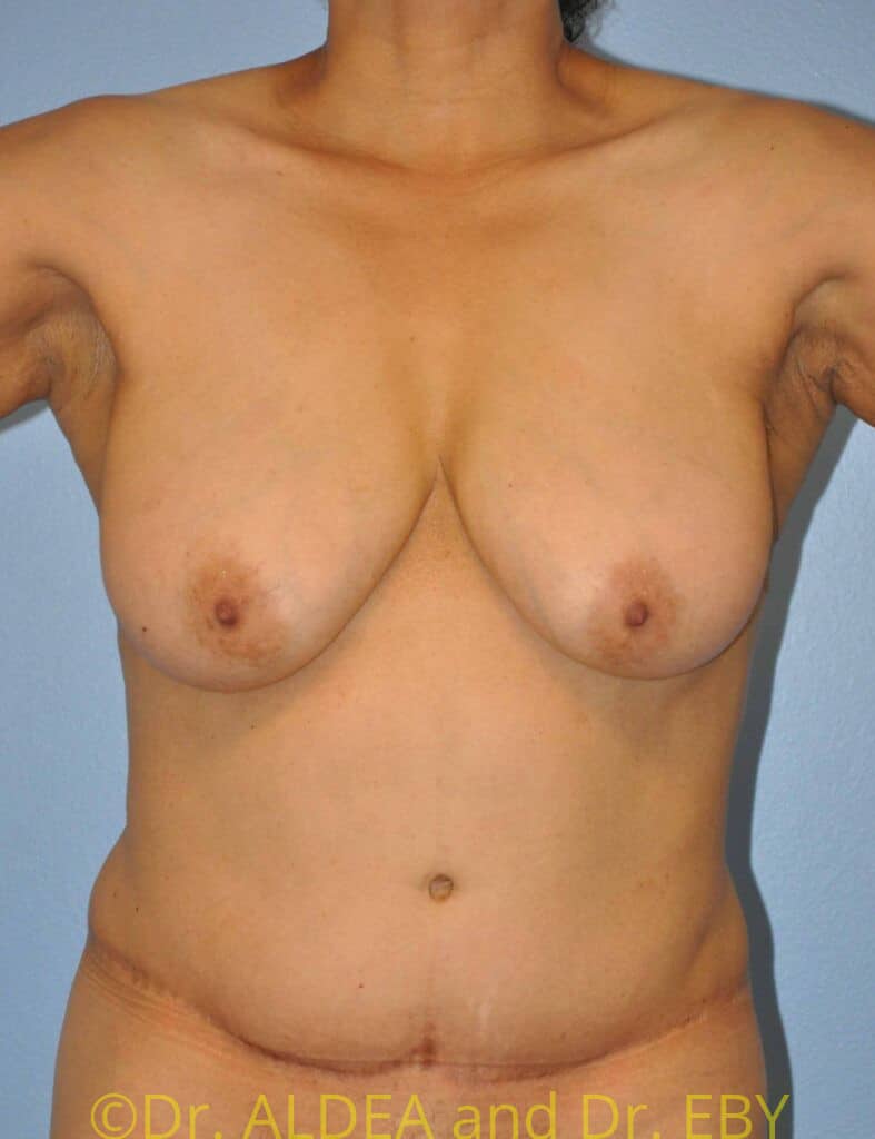 Before Image: Short Scar Breast Lift (Mastopexy) #887 - front