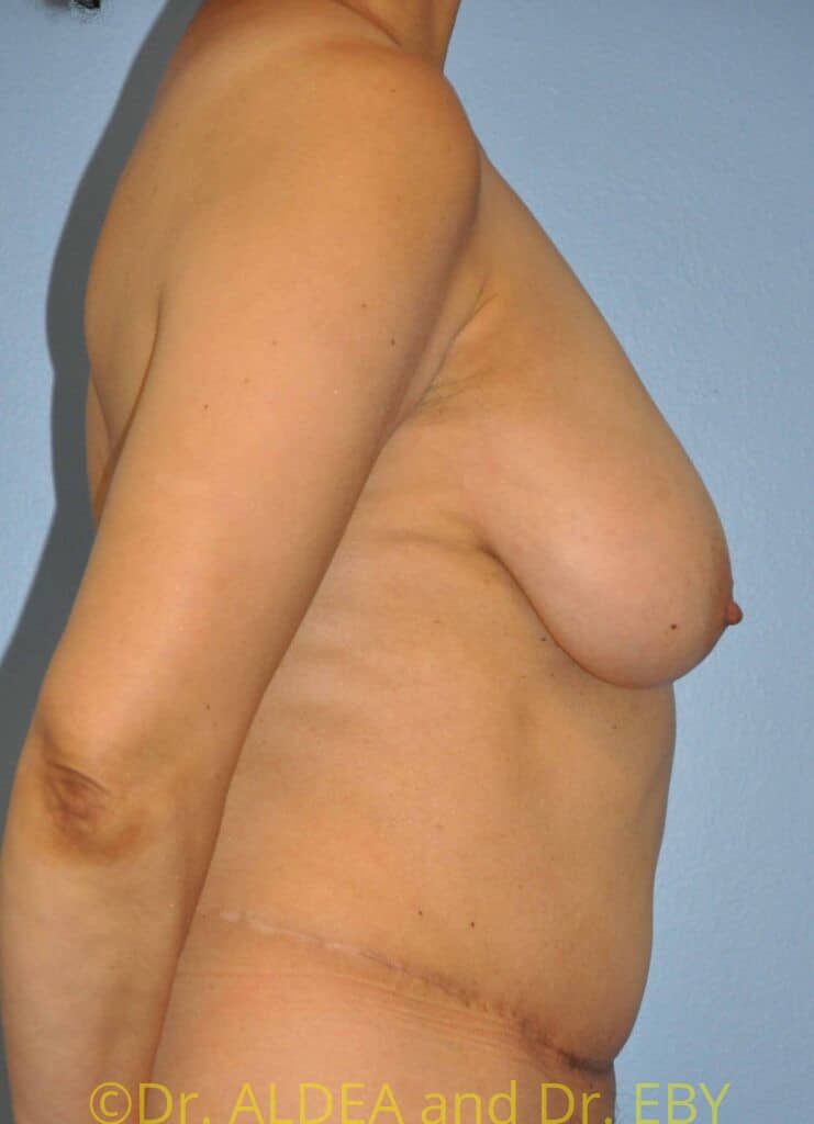 Before Image: Short Scar Breast Lift (Mastopexy) #887 - right-side