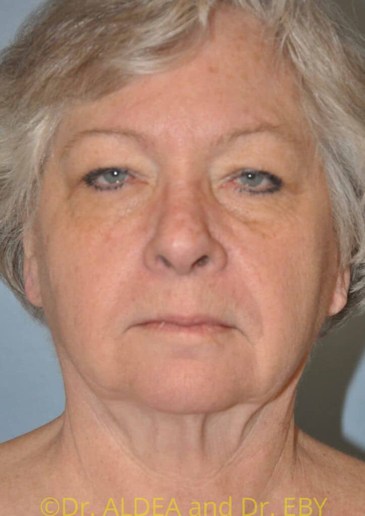Before Image: Facelift #419 - front
