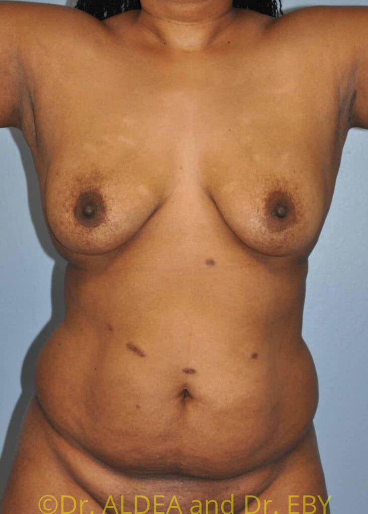 Before Image: Fat Transfer to Breasts #796 - front