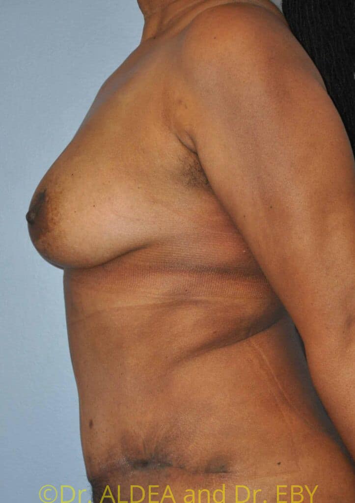 After Image: Fat Transfer to Breasts #796 - left-side