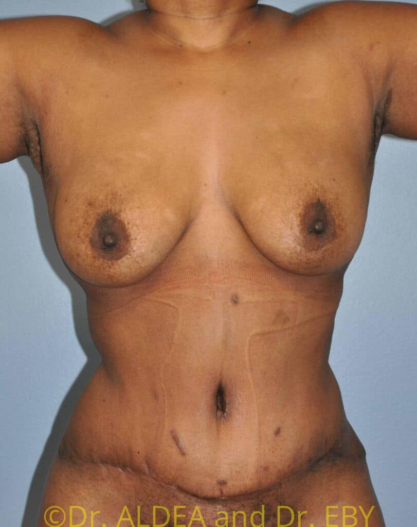 After Image: Fat Transfer to Breasts #796 - front