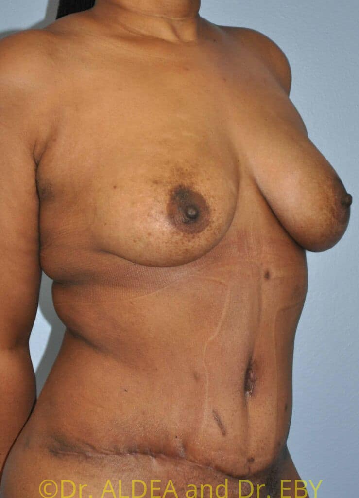 After Image: Fat Transfer to Breasts #796 - right-front-oblique