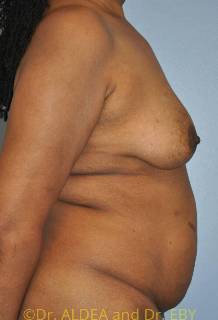 Before Image: Fat Transfer to Breasts #796 - right-side